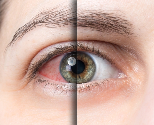 Rotes Auge vor und nach der Behandlung